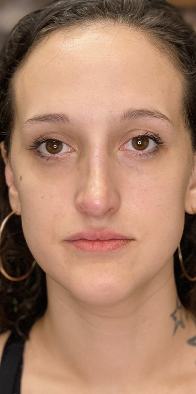 Non Surgical Rhinoplasty Before and After | Northside Plastic Surgery