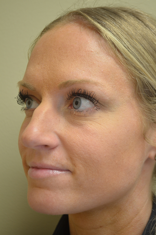 Non Surgical Rhinoplasty Before and After | Northside Plastic Surgery