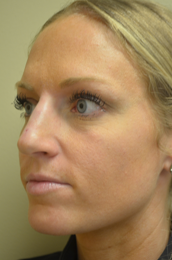 Non-Surgical Rhinoplasty