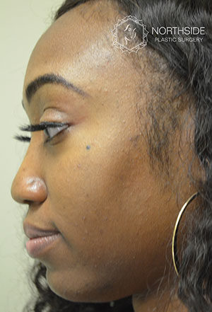 Non-Surgical Rhinoplasty