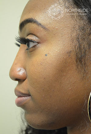 Non-Surgical Rhinoplasty