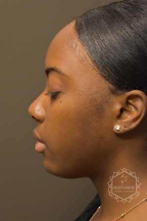 Non Surgical Rhinoplasty Before and After | Northside Plastic Surgery