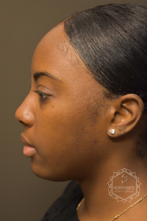 Non Surgical Rhinoplasty Before and After | Northside Plastic Surgery