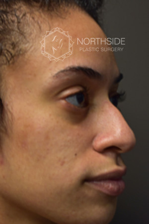 Non Surgical Rhinoplasty Before and After | Northside Plastic Surgery