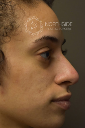 Non Surgical Rhinoplasty Before and After | Northside Plastic Surgery