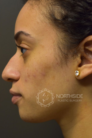 Non Surgical Rhinoplasty Before and After | Northside Plastic Surgery