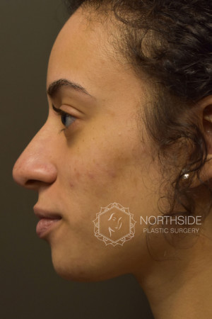 Non Surgical Rhinoplasty Before and After | Northside Plastic Surgery