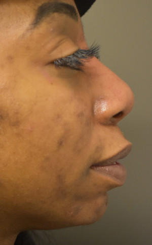 Non Surgical Rhinoplasty Before and After | Northside Plastic Surgery