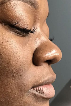 Non Surgical Rhinoplasty Before and After | Northside Plastic Surgery