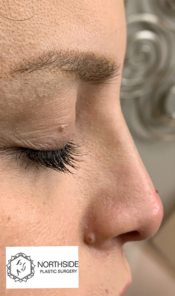 Non Surgical Rhinoplasty Before and After | Northside Plastic Surgery