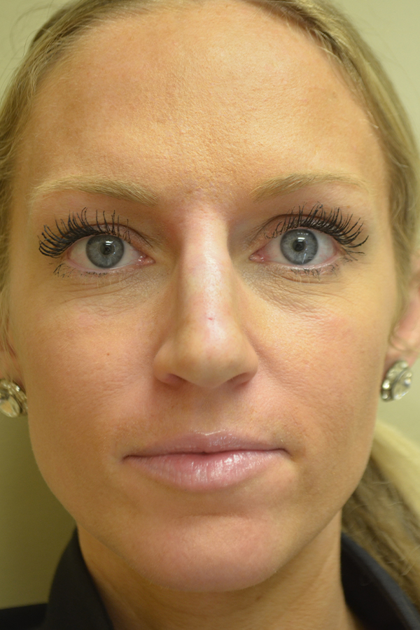 Non Surgical Rhinoplasty Before and After | Northside Plastic Surgery