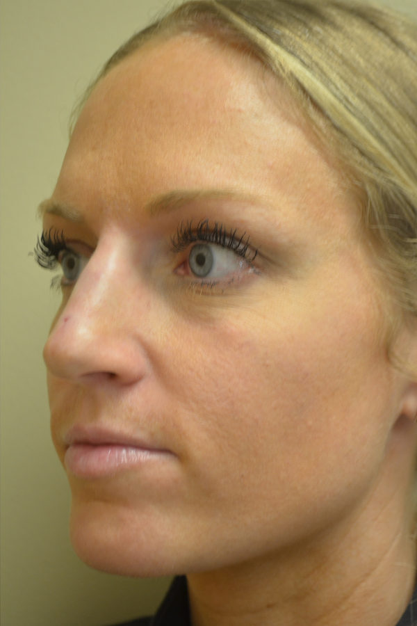 Non Surgical Rhinoplasty Before and After | Northside Plastic Surgery