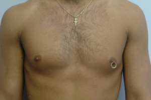 Pectoral Augmentation Before and After | Northside Plastic Surgery