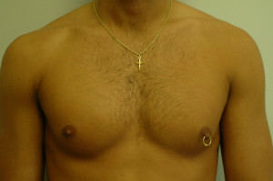 Pectoral Augmentation Before and After | Northside Plastic Surgery