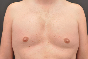 Pectoral Augmentation Before and After | Northside Plastic Surgery