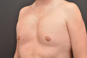 Pectoral Augmentation Before and After | Northside Plastic Surgery