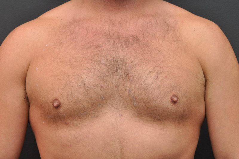 Pectoral Augmentation Before and After | Northside Plastic Surgery