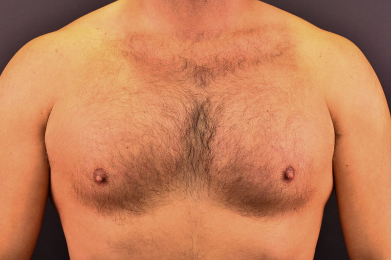 Pectoral Augmentation Before and After | Northside Plastic Surgery