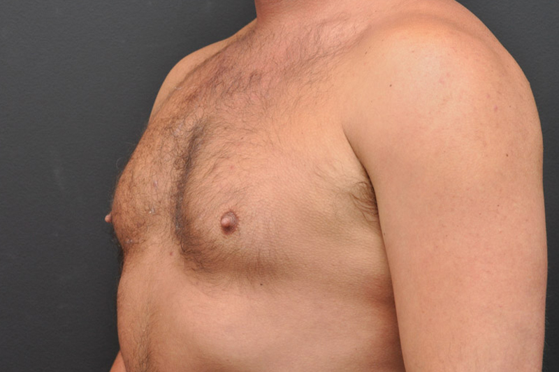 Pectoral Augmentation Before and After | Northside Plastic Surgery