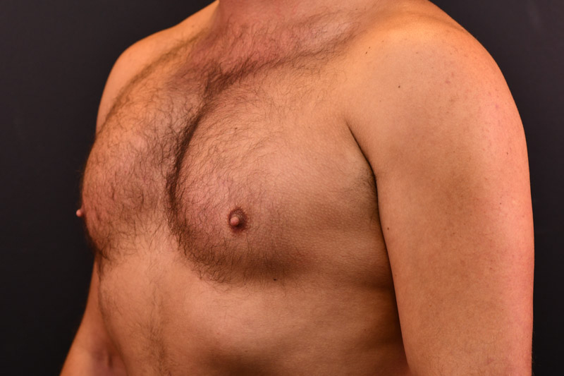 Pectoral Augmentation Before and After | Northside Plastic Surgery