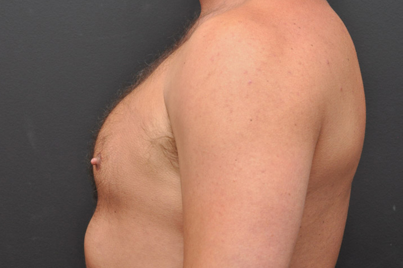 Pectoral Augmentation Before and After | Northside Plastic Surgery