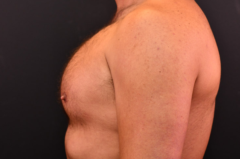 Pectoral Augmentation Before and After | Northside Plastic Surgery