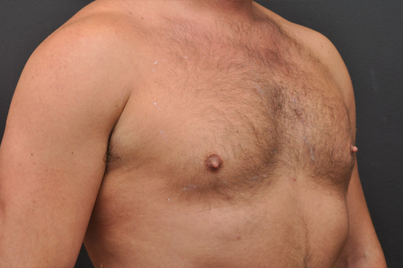 Pectoral Augmentation Before and After | Northside Plastic Surgery