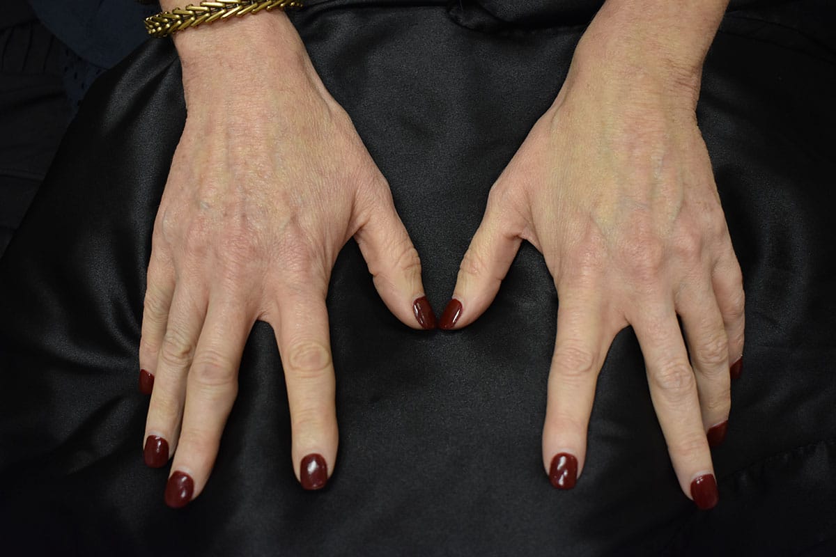 Restylane For Hands Before and After | Northside Plastic Surgery