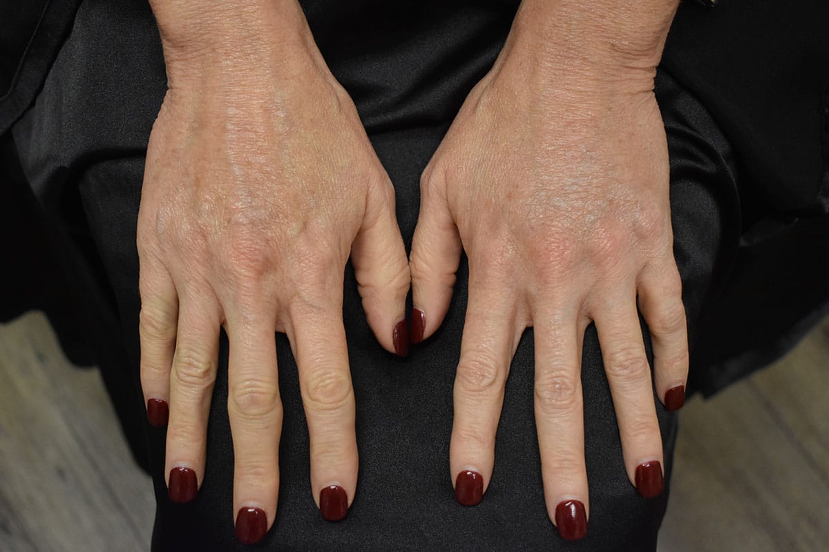 Restylane For Hands Before and After | Northside Plastic Surgery
