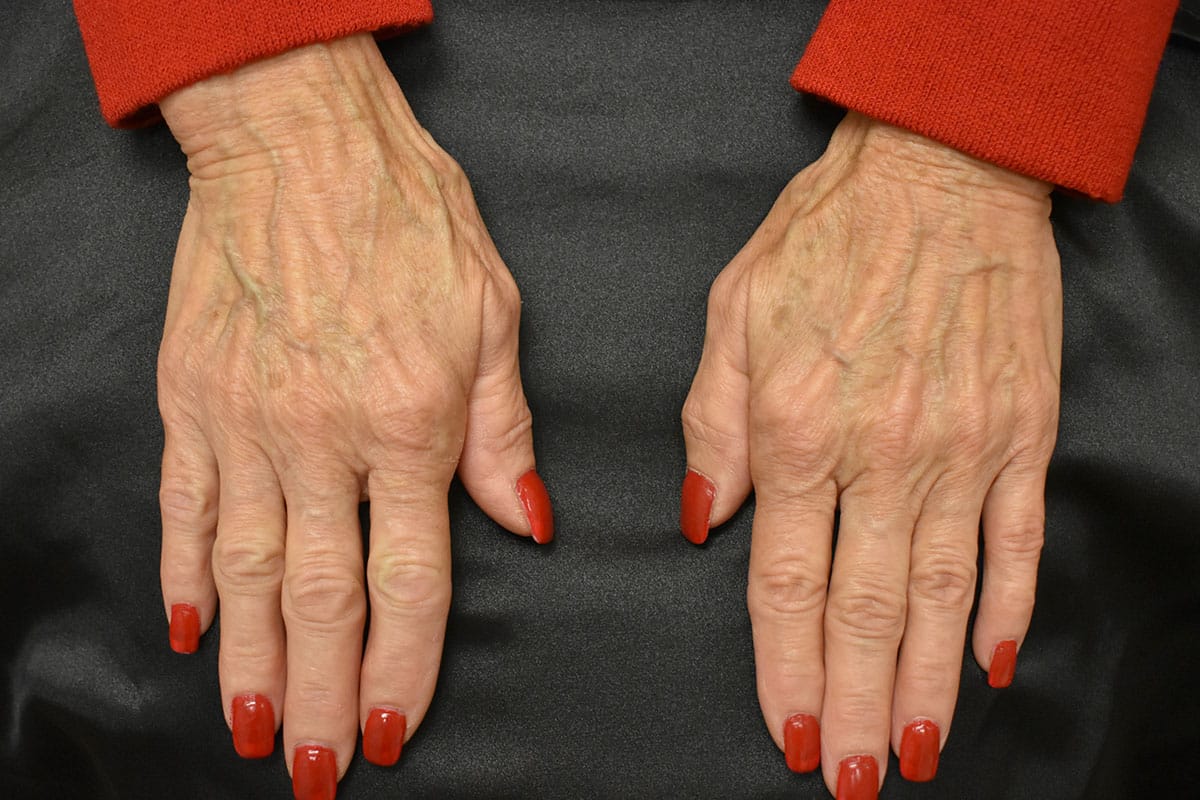 Restylane For Hands Before and After | Northside Plastic Surgery