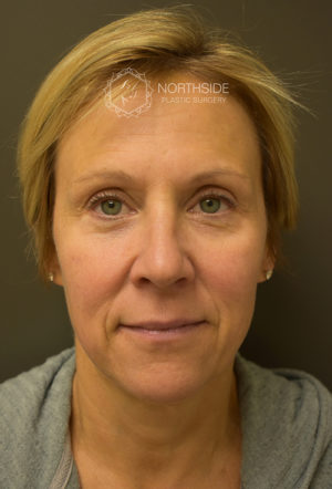 Restylane Before and After | Northside Plastic Surgery