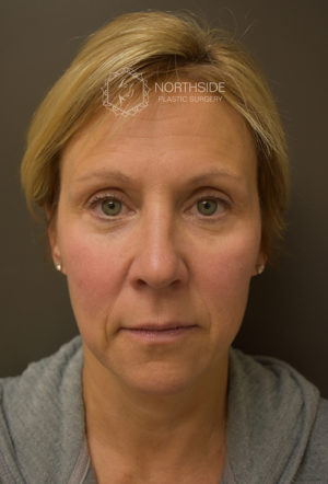 Restylane Before and After | Northside Plastic Surgery