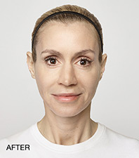 Restylane Before and After | Northside Plastic Surgery