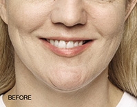 Restylane Before and After | Northside Plastic Surgery