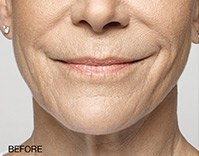 Restylane Before and After | Northside Plastic Surgery