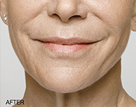 Restylane Before and After | Northside Plastic Surgery