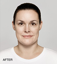 Restylane Before and After | Northside Plastic Surgery