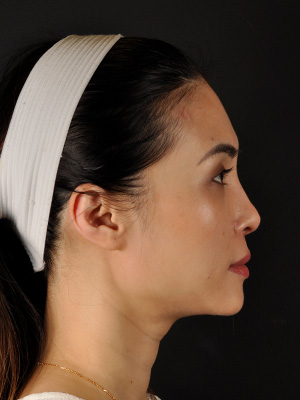 Rhinoplasty Before and After | Northside Plastic Surgery