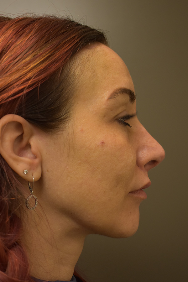 Rhinoplasty Before and After | Northside Plastic Surgery