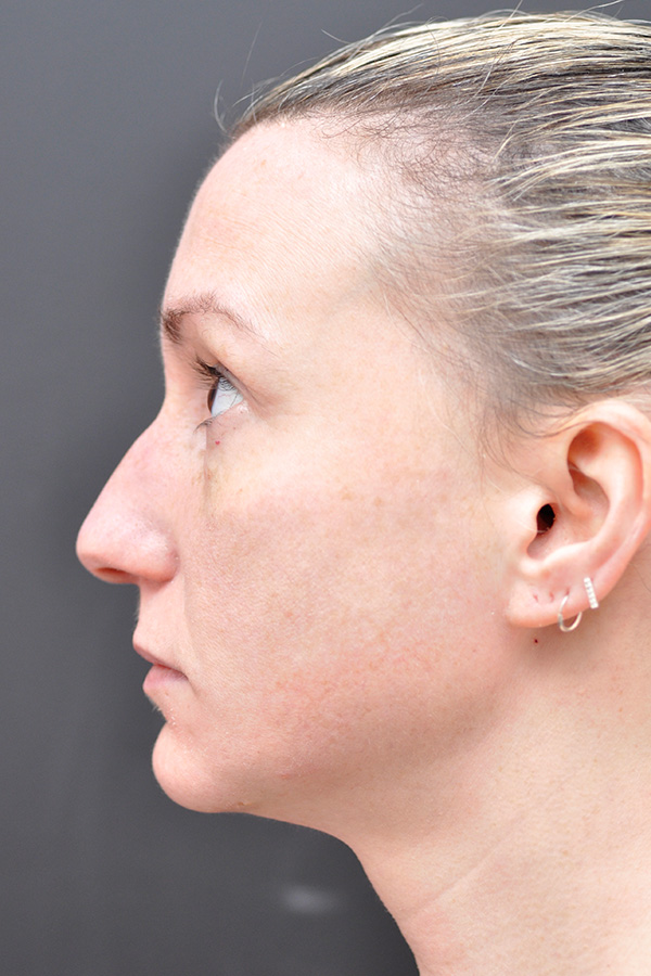 Rhinoplasty Before and After | Northside Plastic Surgery