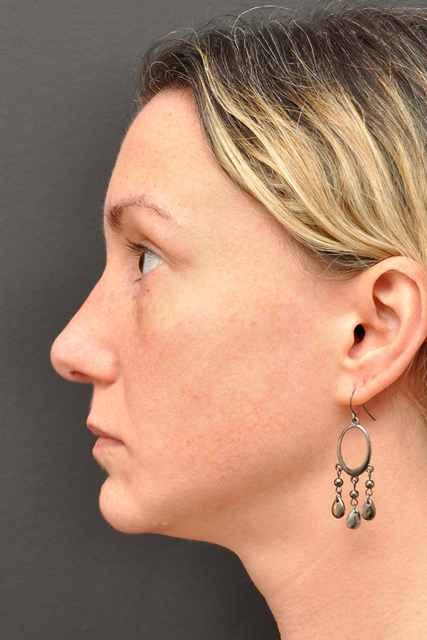 Rhinoplasty Before and After | Northside Plastic Surgery