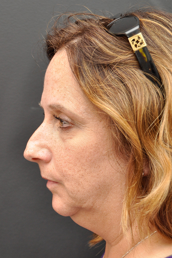 Rhinoplasty Before and After | Northside Plastic Surgery