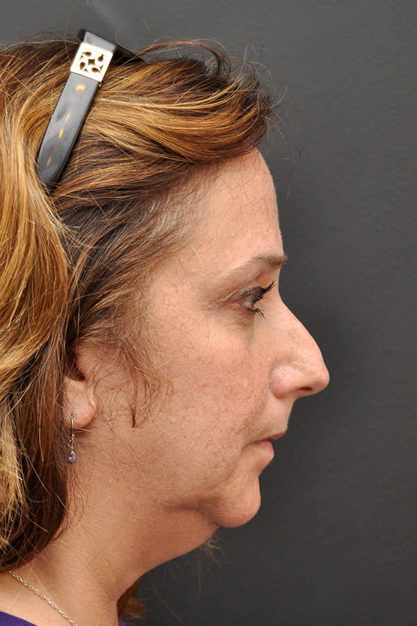 Rhinoplasty Before and After | Northside Plastic Surgery