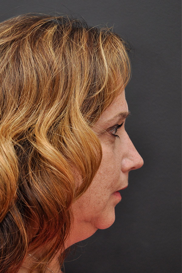 Rhinoplasty Before and After | Northside Plastic Surgery