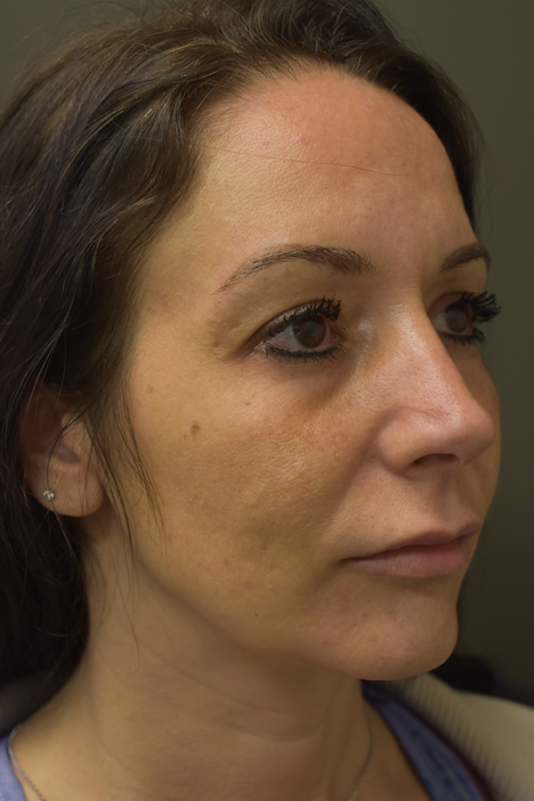 Rhinoplasty Before and After | Northside Plastic Surgery