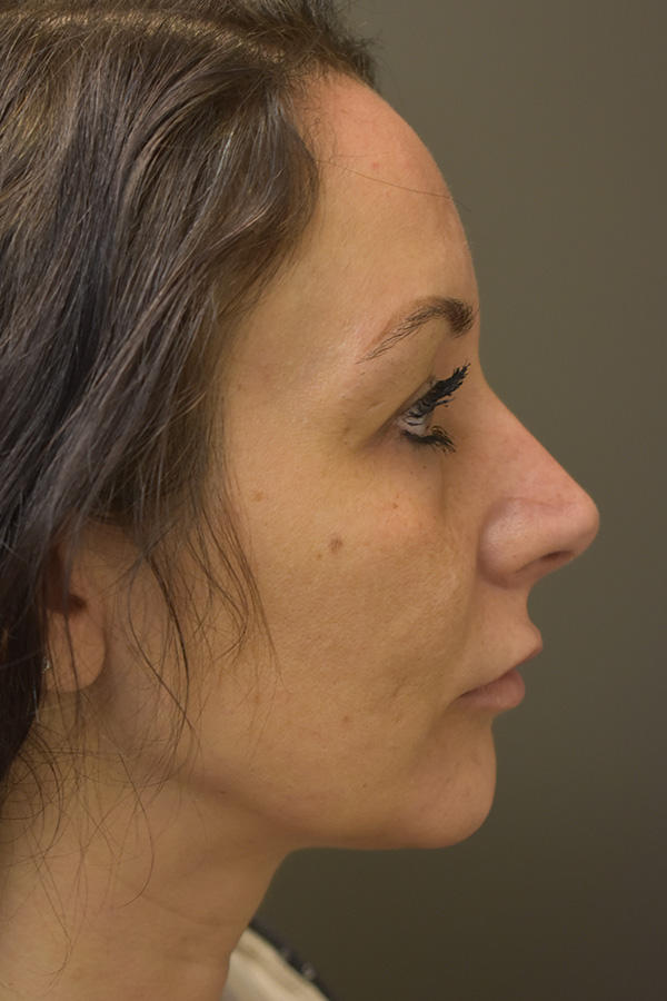 Rhinoplasty Before and After | Northside Plastic Surgery