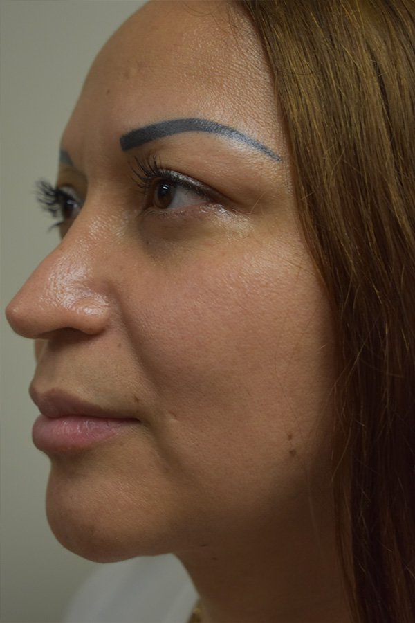 Rhinoplasty Before and After | Northside Plastic Surgery