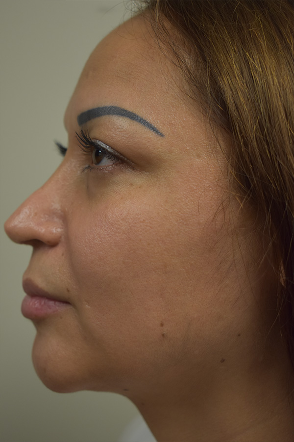 Rhinoplasty Before and After | Northside Plastic Surgery