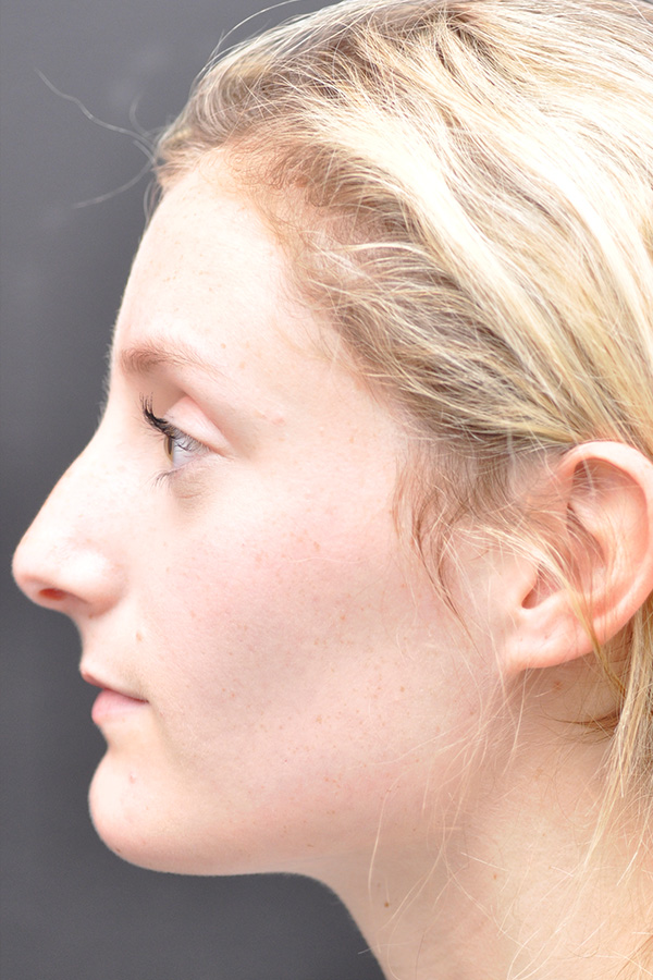 Rhinoplasty Before and After | Northside Plastic Surgery