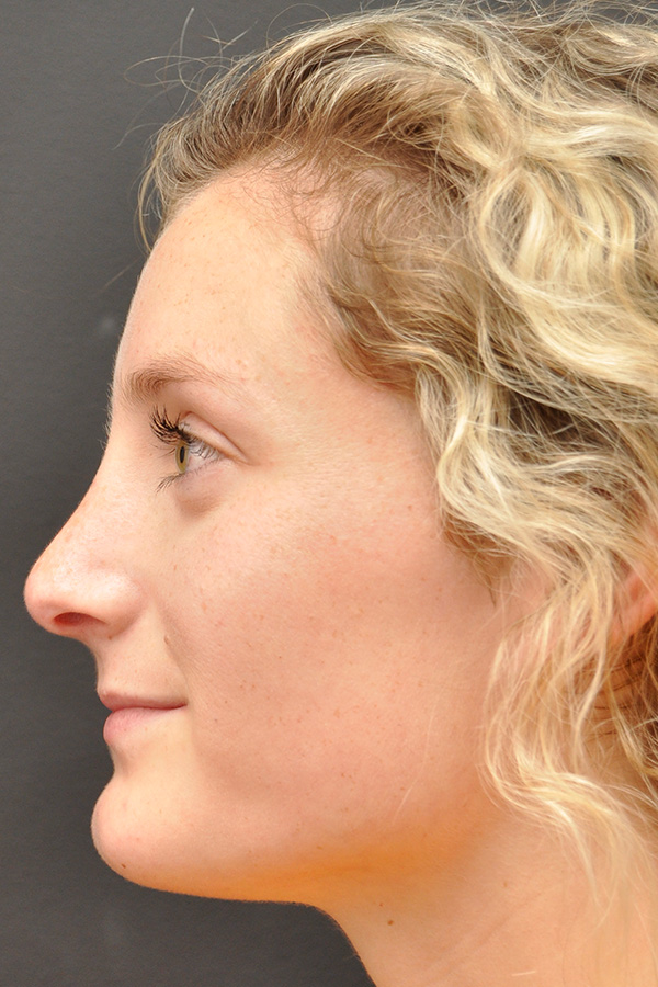 Rhinoplasty Before and After | Northside Plastic Surgery